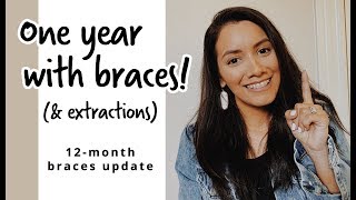 ONE YEAR WITH BRACES (AFTER 4 EXTRACTIONS)   TIME LAPSE | 12-month braces update