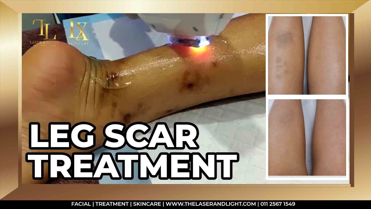 Flawless Leg Scar Treatment ⚡️[The Laser & Light Medical] 