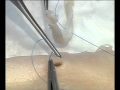 Cardiac Surgical Skills Laboratory - Proximal Anastamosis Parachute Technique CABG