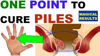 Sujok Therapy For Piles||Acupressure Points For Piles||Sujok Seed Therapy For Piles