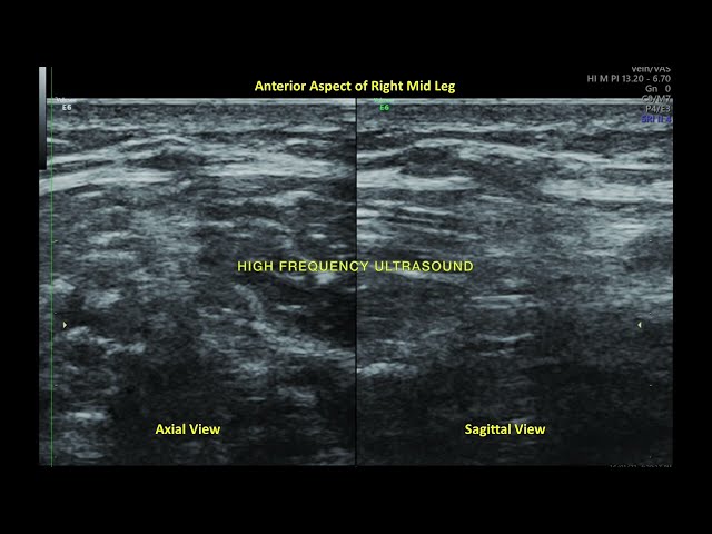 Tibialis Anterior Muscle Hernia - Ultrasound