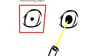 Reverse Afferent Pupillary Defect (Positive and Negative)