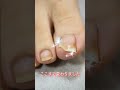 フレックスプレート巻き爪ケアビフォーアフター