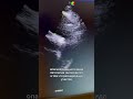 #здоровье #медицина #сердце #гипертония #аорта #кардиолог #сердце