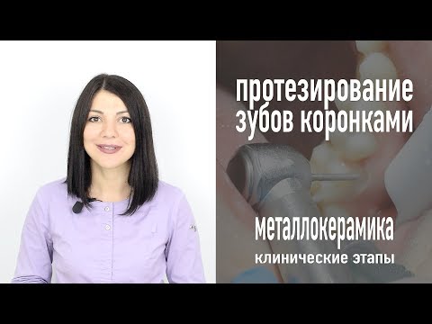 Металлокерамические коронки, клинические этапы протезирования | стоматология Самара