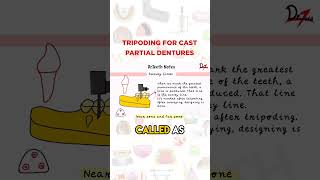 Tripoding For Cast Partial Dentures