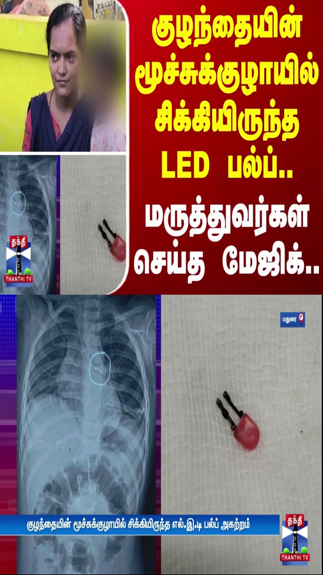 குழந்தையின் மூச்சுக்குழாயில் சிக்கியிருந்த எல்.இ.டி பல்ப்..  மருத்துவர்கள் செய்த மேஜிக்..