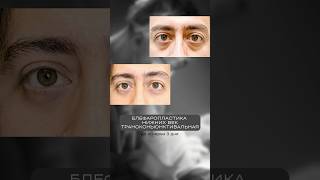 ДО и ПОСЛЕ у пластического хирурга Ли Александра #shorts #блефаропластика #пластическийхирург