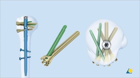 Humerus, Proximal - 3-Part Fracture - Reconstruction Using the MultiLoc Proximal Humeral Nail