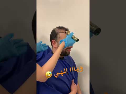 تجربتي عن زراعة الشعر في تركيا