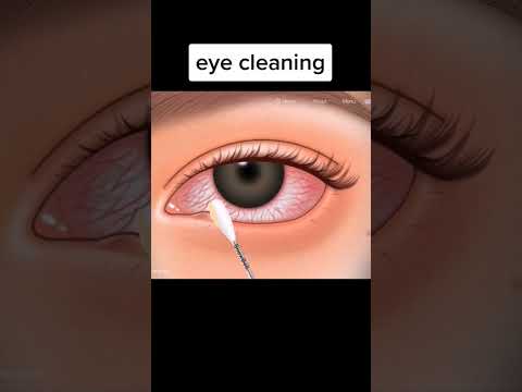 كيفية علاج التهاب الجفون المزمن      تمريضكم تمريض طب قبالة