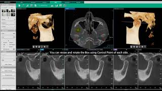 Ez3D-i | TMJ Tab | Manipulate the Image for TMJ Evaluation