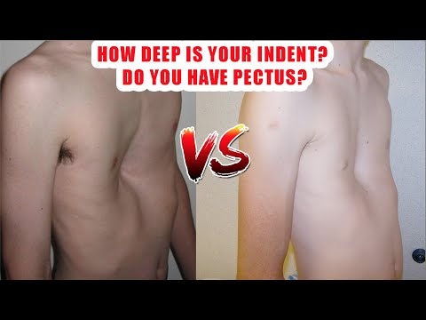 Video: Pectus Excavatum øvelser: Forbedre Styrken