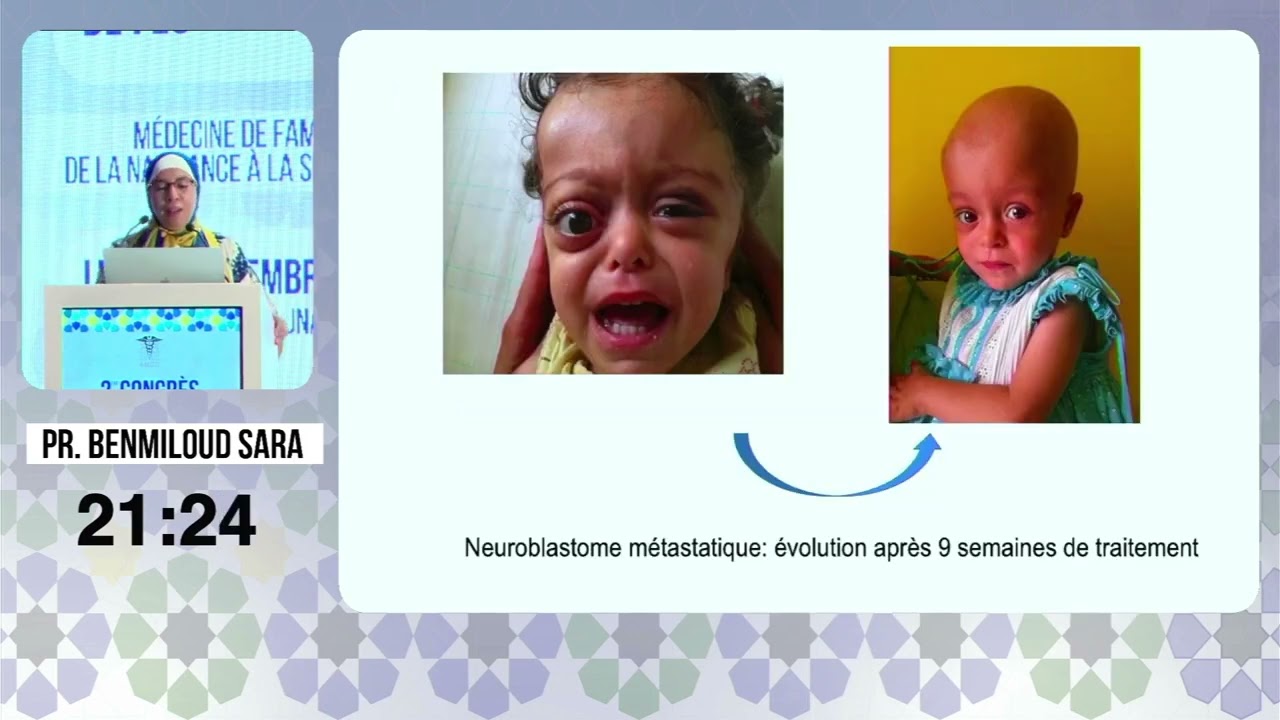 01 CANCERS CHEZ L’ENFANT   COMMENT ET QUAND Y PENSER ? Pr  benmiloud sara