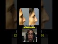 Liquid Rhinoplasty: A Non-Surgical Solution for a Straighter Nose | Dr. Michelle Hardaway