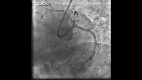 Complex PCI for LCX ostial lesion video 12