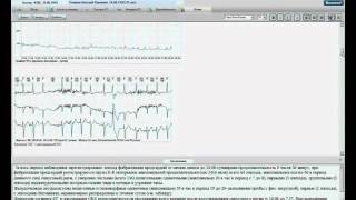 видео Комплекс холтеровского мониторирования ЭКГ Валента