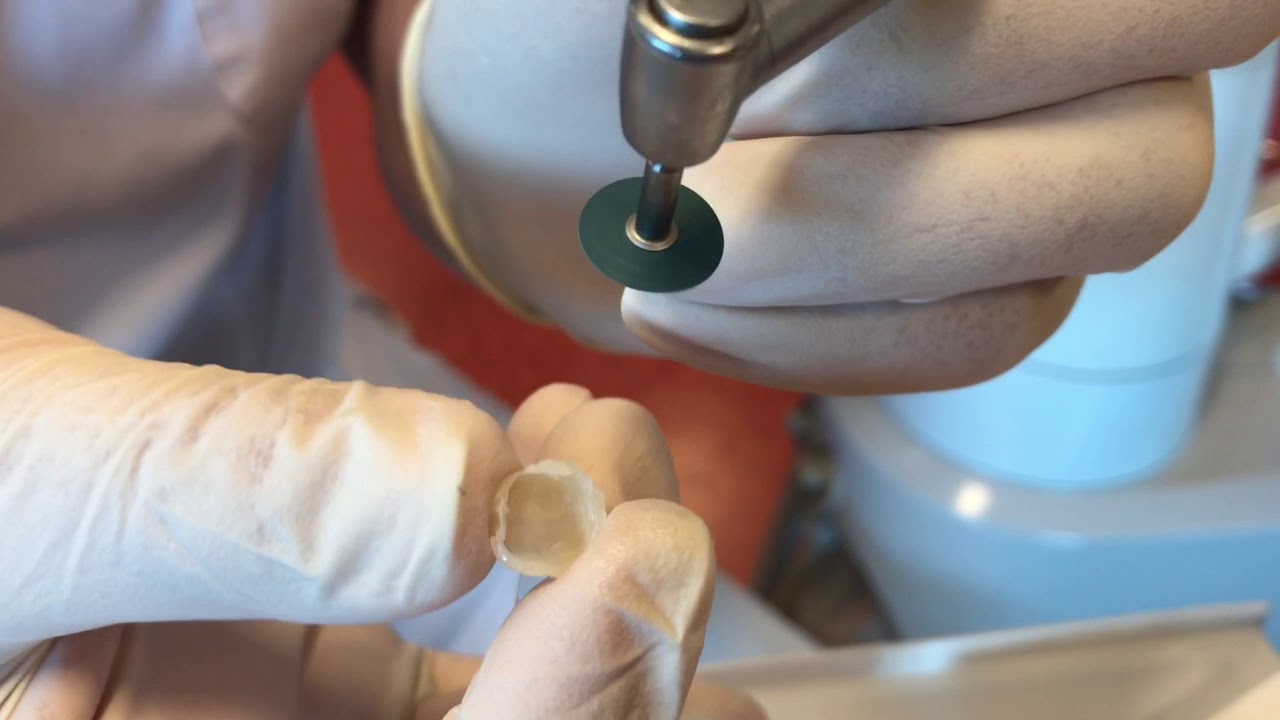 Korte instructievideo: Het maken en plaatsen van een noodkroon