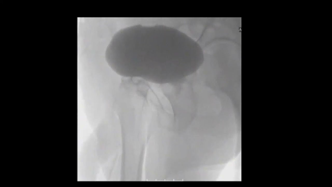 Urolift（ウロリフト）とは？｜泌尿器・日帰り手術クリニック uMIST 