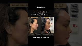 Your Face Day 1 After a Deep Plane Facelift: What to Expect