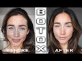 BOTOX TREATMENT BEFORE & AFTER