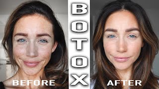 BOTOX TREATMENT BEFORE & AFTER