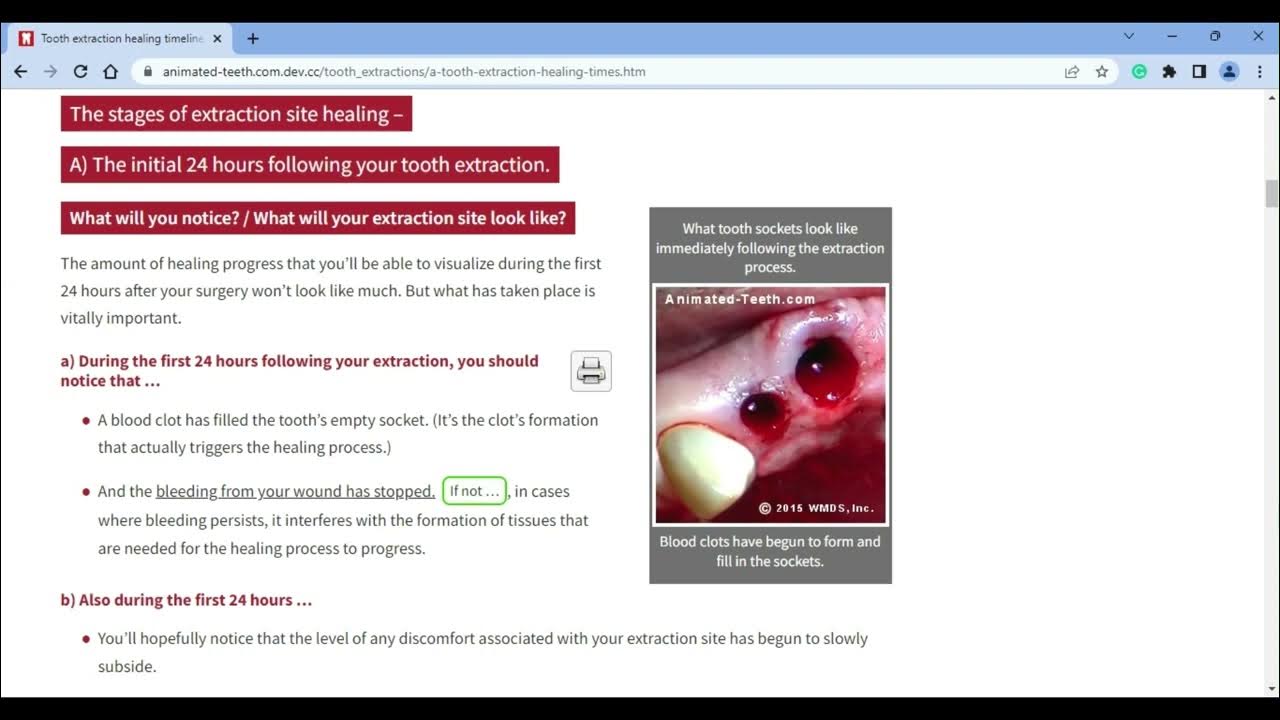 Tooth extraction healing timeline YouTube