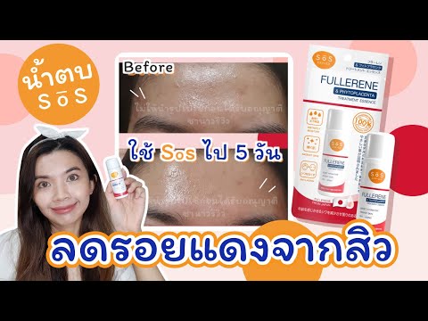 รีวิว SoS น้ำตบ เอสเซ้น ลดการเกิดสิว รอยแดงสิว Fullerene & Phytoplacenta ผิวแพ้ง่าย l Kalukpukpik