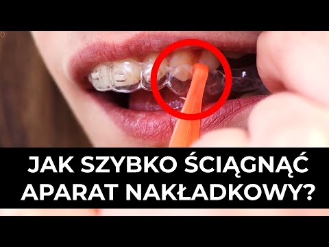 Aparat nakładkowy Secret Ortho- jak szybko ściągnąć?