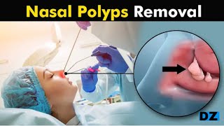 Nasal Polyps and their treatment Howolypectomy is Performed? (Urdu/Hindi)