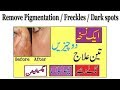 Remove pigmentation  freckles  dark spots on face anam home remedy