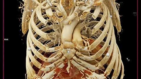 Parathyroid Adenoma with Cinematic Rendering