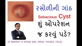 Sebaceous cyst information in gujarati- રસોળીની ગાંઠ વિશે ગુજરાતીમા માહિતી #cyst #cystremoval #રસોળી