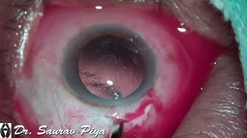 SUB-INCISIONAL CORTEX REMOVAL FROM MAIN PORT BY SIMCOE CANNULA - Dr. Saurav Piya