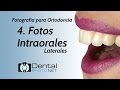 Fotografía para Ortodoncia. 4- Fotos Intraorales (Laterales)