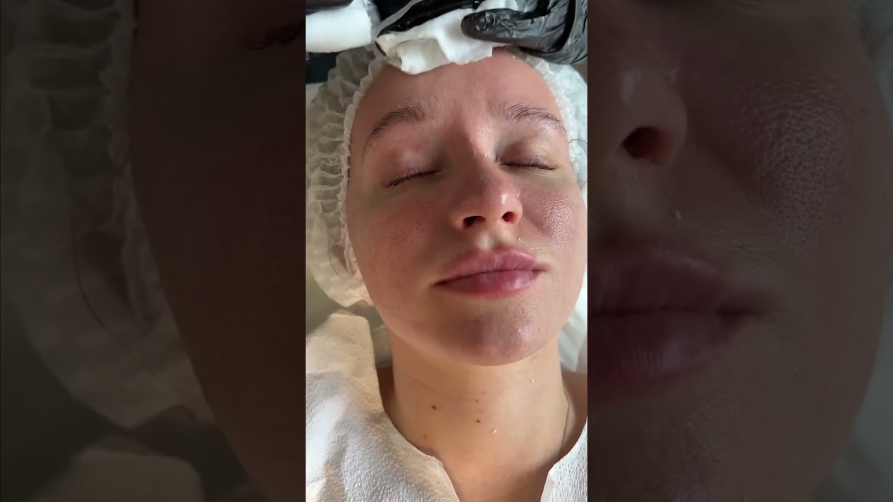 AviClear Acne Treatment: Discover The Future Of Clear Skin