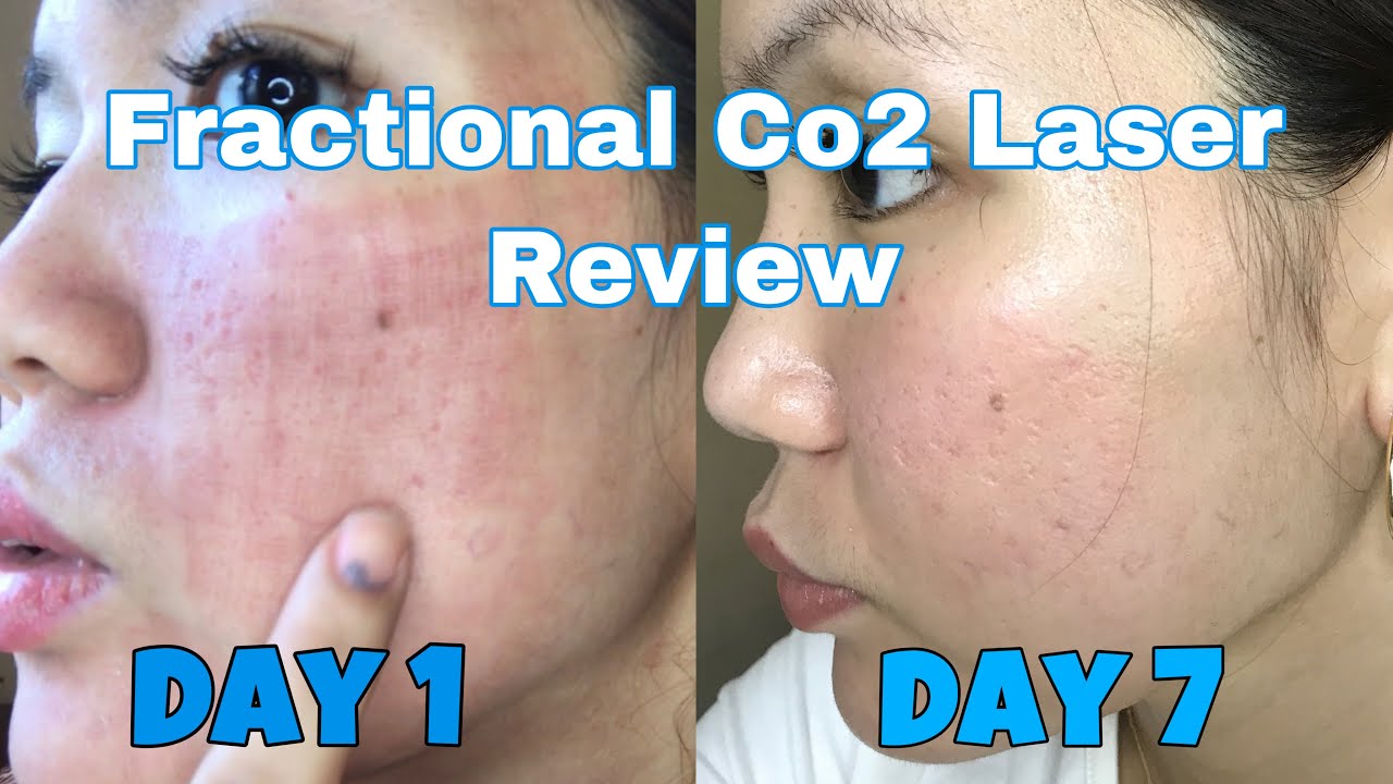 FRACTIONAL CO2 LASER AFTER TREATMENT REVIEW | DAY 1 TO DAY 7 | VLOG 5