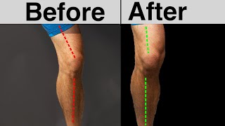 Fix Your Knee Caving in FOR GOOD