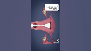 أشعة بالصبغة علي الرحم Learning Medical اشعة Reels How Shortvideo Shorts Shor Reel 