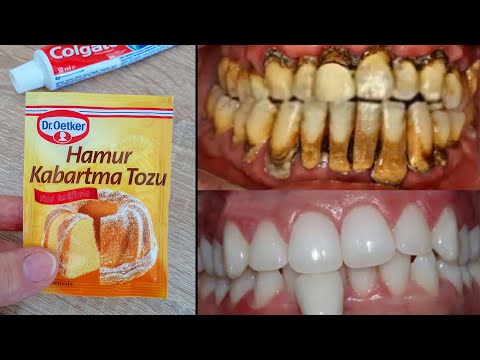 Sadece 2 dakikada diş beyazlatma - evde dişler nasıl beyazlatılır? % 100 etkili