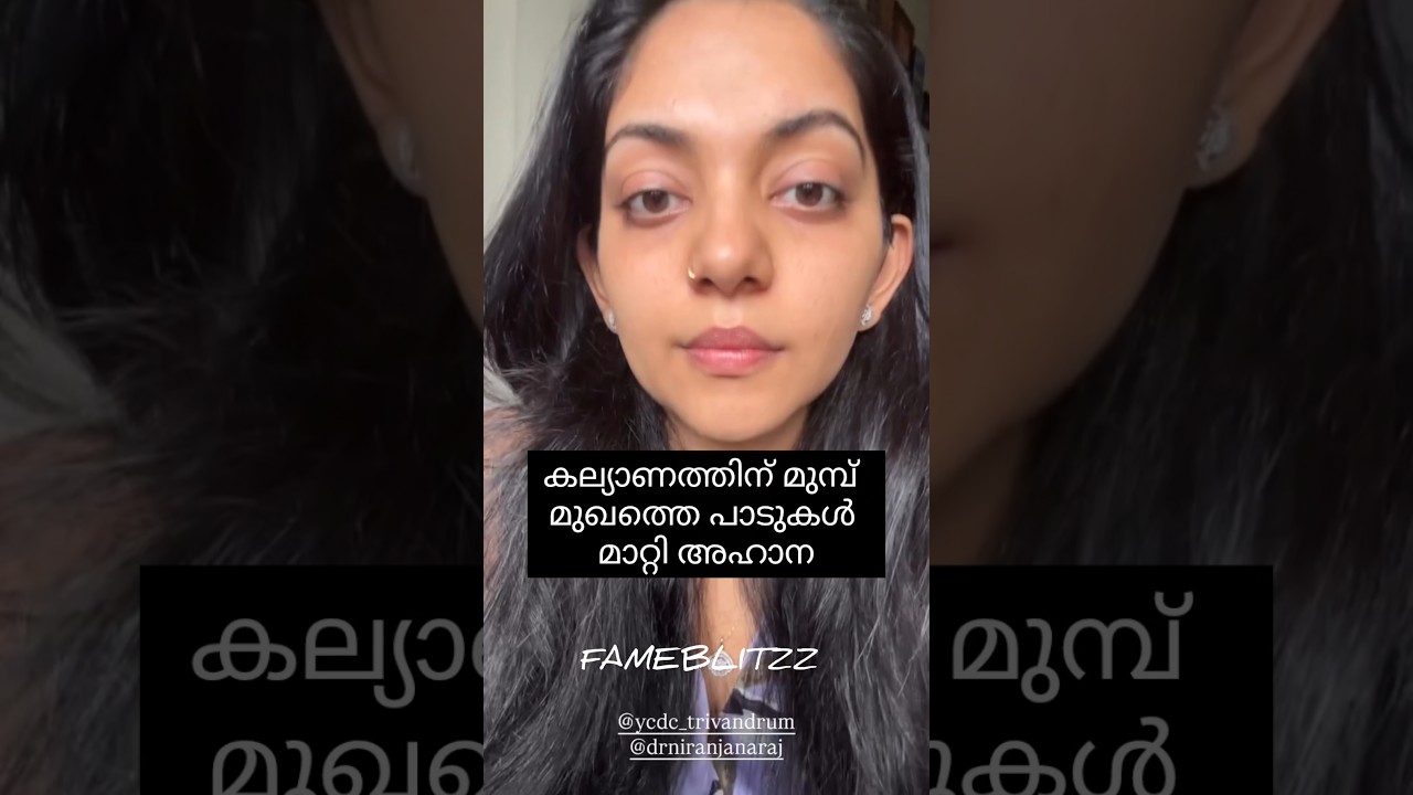 Ahaana krishna’s skin care |How to reduce Dark spots Laser Toning treatment #ahaanakrishna#darkspots