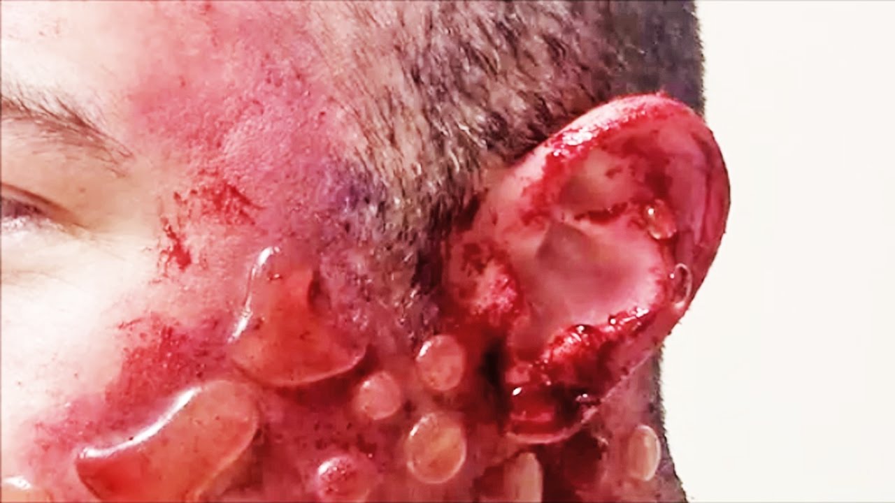Mustard Gas! What Happened Here? - YouTube
