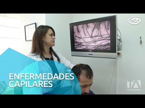 Vídeo: Condiciones Del Cuero Cabelludo: Imágenes, Causas Y Tratamientos