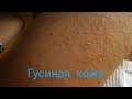 Гусиная кожа. Фолликулярный кератоз. Аптечные средства от гусиной кожи.