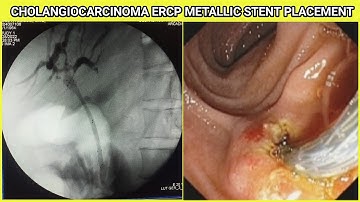 Cholangiocarcinoma ERCP Metallic Stent Deployment Dhaka Bangladesh #BD_ENDOSCOPY