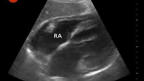 Video 3   Subxiphoid view demonstrating pericardial effusion with diastolic collapse