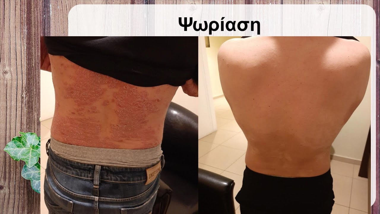 Πως μπορούμε να θεραπεύσουμε την Ψωρίαση και την Ψωριασική Αρθρίτιδα; Κεφάλαιο Αυτοάνοσα Νοσήματα