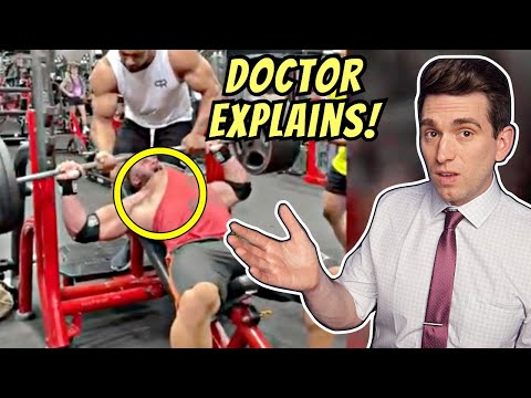 Doctor Reacts to Larry Wheels RUPTURED PEC Video of Ryan Crowley and Explains Injury