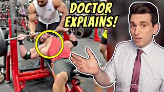 Doctor Reacts to Larry Wheels RUPTURED PEC Video of Ryan Crowley and Explains Injury