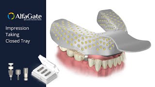 Implant impression taking- closed tray | Alfa Gate
